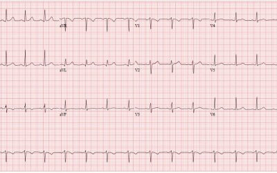 ECG